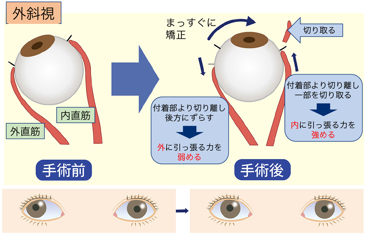 斜視専門外来のご案内 香川県坂出市の小児眼科 一般眼科なら沖津眼科クリニックへ
