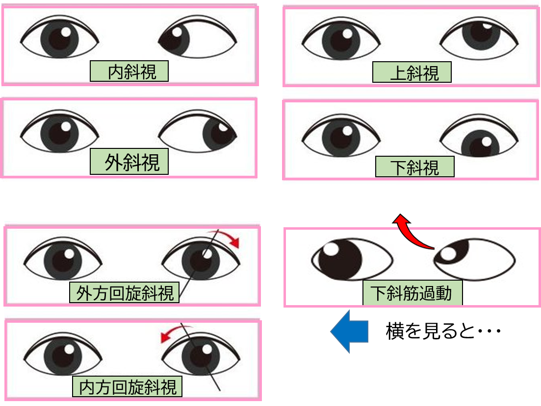 斜視専門外来のご案内 香川県坂出市の小児眼科 一般眼科なら沖津眼科クリニックへ